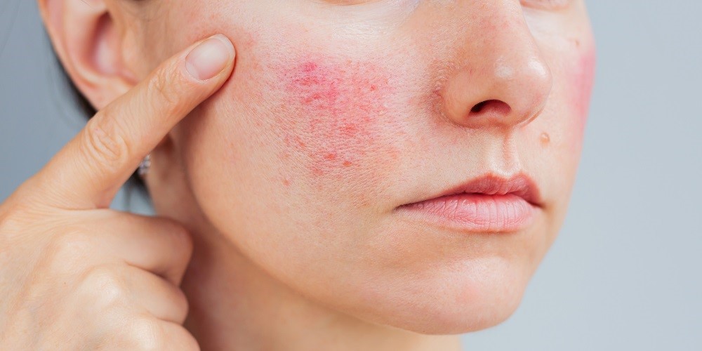 酒糟肌保養品推薦｜了解成因，教你正確的酒糟肌保養對策！